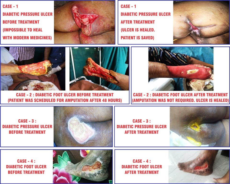 diabetic ulcer cases after treatment