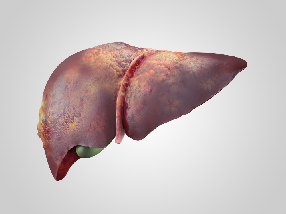 liver cirrhosis clinic in vadodara gujarat
