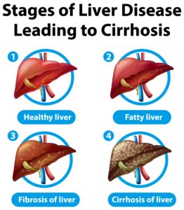 best ayurvedic hospital for liver cirrhosis in vadodara gujarat
