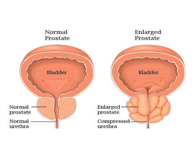 prostate normal and enlarged